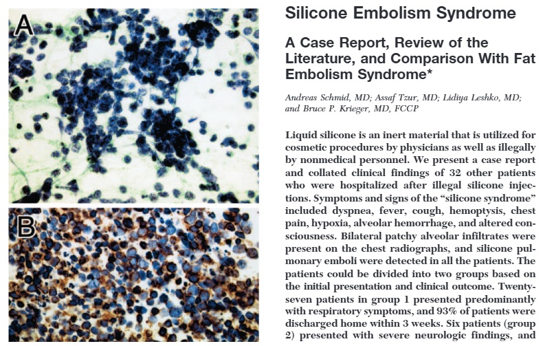 Un estudio confirma los efectos de embolia en personas que se aplicaron silicona líquida.